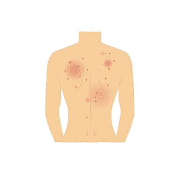 Stylized torso illustration with focal tender points highlighted — ACNES pain sits in the anterior abdominal wall