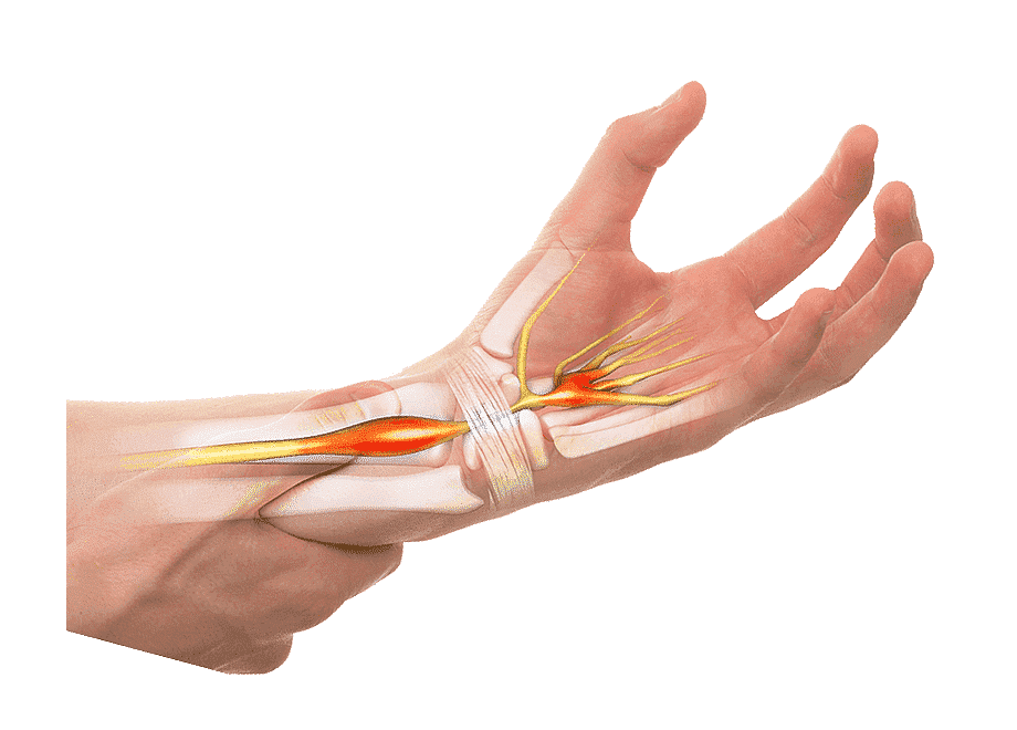 Palm-up view of the hand showing the median nerve under the carpal tunnel ligament with inflammation highlights