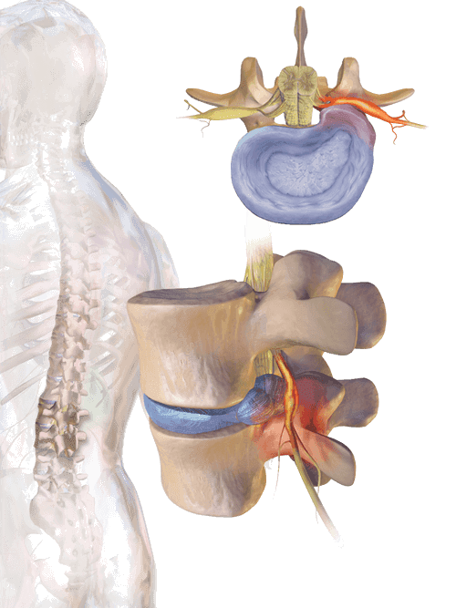 Herniated disc compressing a nerve root — axial and side views of cervical radiculopathy