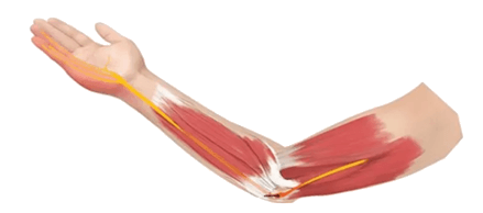 Bent arm showing the ulnar nerve at the inner elbow with pinky-side hand symptoms highlighted