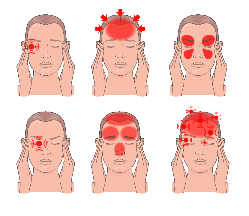 Illustration of headache and migraine pain patterns across the head