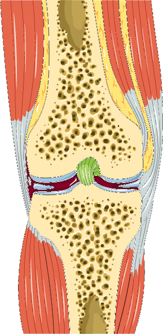Cross-section illustration of a knee joint with osteoarthritis changes