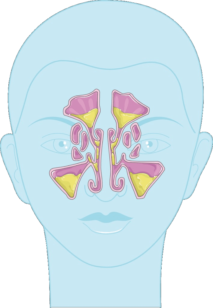 Illustration of facial sinuses with mucus buildup from a sinus infection