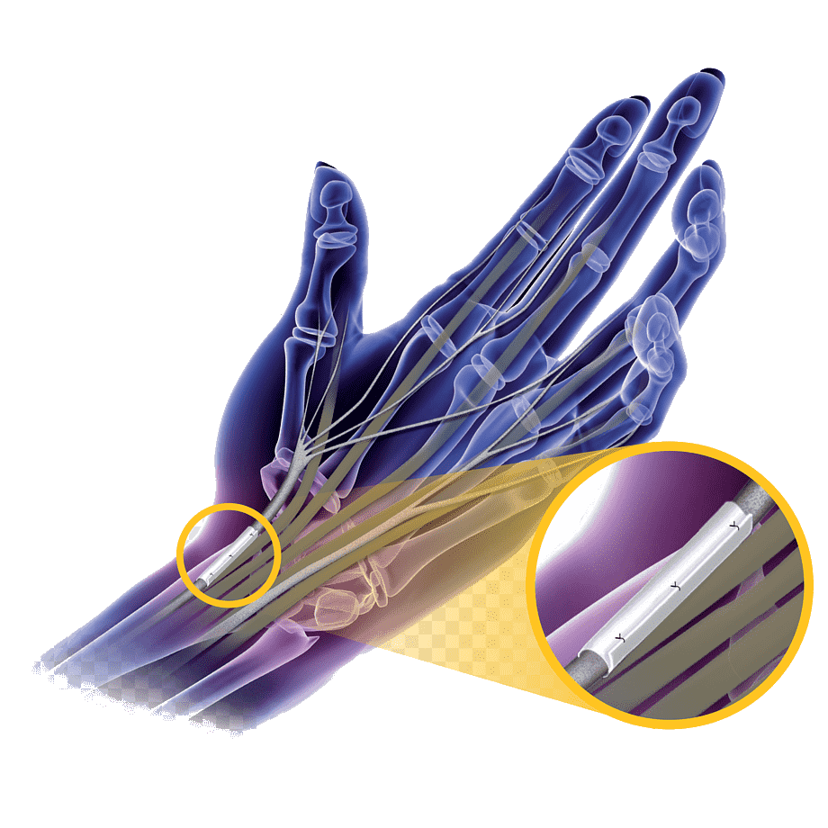 Palm-up hand illustration highlighting the ulnar nerve at Guyon’s canal on the pinky side of the wrist